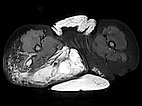 MRT – Klippel-Trénaunay-Syndrom, Lymphorrhoe am Bein