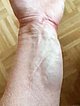 Venöse Malformation an Unterarm