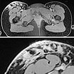 MRT T1 Wichtung – Lymphatische Malformation