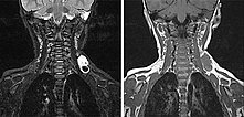 MRT – Venöse Malformation am Hals