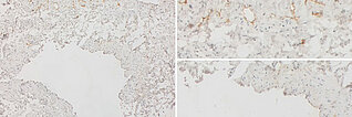 Immunhistologische Färbung – Kombinierte venolymphatische Malformation