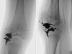 Röntgenbild – PTEN-Hamartom-Syndrom am Knie