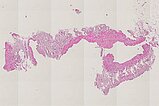 Biopsiepräparat – Kombinierte venolymphatische Malformation