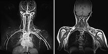 MR-Angiographie/MRT – Arteriovenöse Malformation an Hals/Thorax