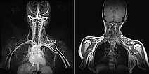 MR-Angiographie/MRT – Arteriovenöse Malformation an Hals/Thorax