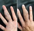Arteriovenöse Malformation am Finger
