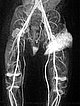 MR-Angiographie – Non-Involuting Congential Hemangioma (57s)