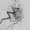 Digitale Subtraktionsangiographie – Stirn