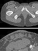 Computertomographie – Lymphatische Malformation