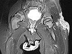 MRT – Non-Involuting Congential Hemangioma