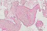 Histopathologie HE-Färbung – Intramuskuläre venöse Malformation