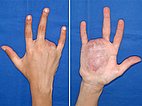 Arteriovenöse Malformation an Hand