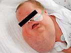 Lymphatische Malformation – Gesicht