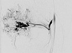 DSA – PTEN-Hamartom-Syndrom am Knie