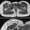 MRT T2 Wichtung – Lymphatische Malformation