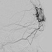 Digitale Subtraktionsangiographie – Stirn