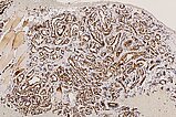 Histologie WT1-Färbung – Subkutanes infantiles Hämangiom