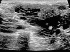 Sonographie – Venöse Malformation am Hals