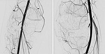 DSA – PTEN-Hamartom-Syndrom am Knie