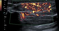 Dopplersonographie – Subkutanes infantiles Hämangiom