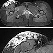 MRT T2 Wichtung – Lymphatische Malformation