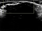 Farbkodierte Duplexsonographie – Proteus-Syndrom