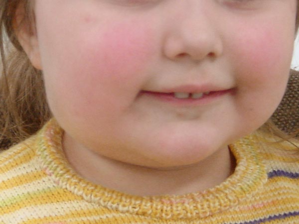Infantiles Hämangiom an Hals –nach erfolgreicher Therapie