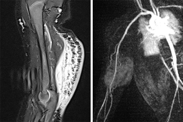 MRT – Kaposiformes Hämangioendotheliom