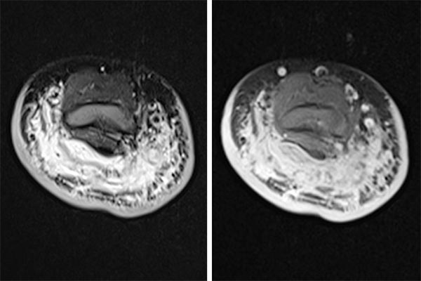 MRT – Kaposiformes Hämangioendotheliom