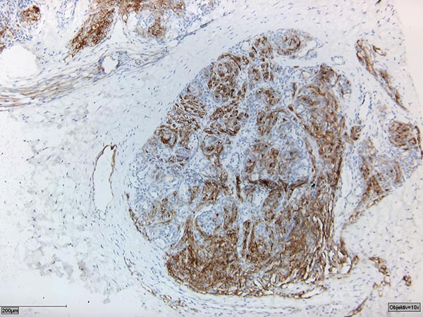 Kaposiformes Hämangioendotheliom – Histologie