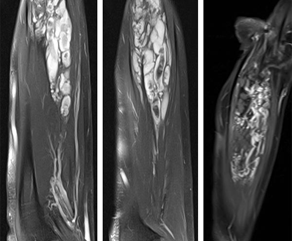 MRT – Venöse Malformation an Unterarm