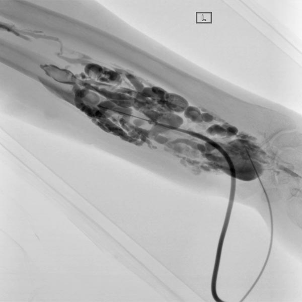 Sklerosierung – Venöse Malformation an Unterarm