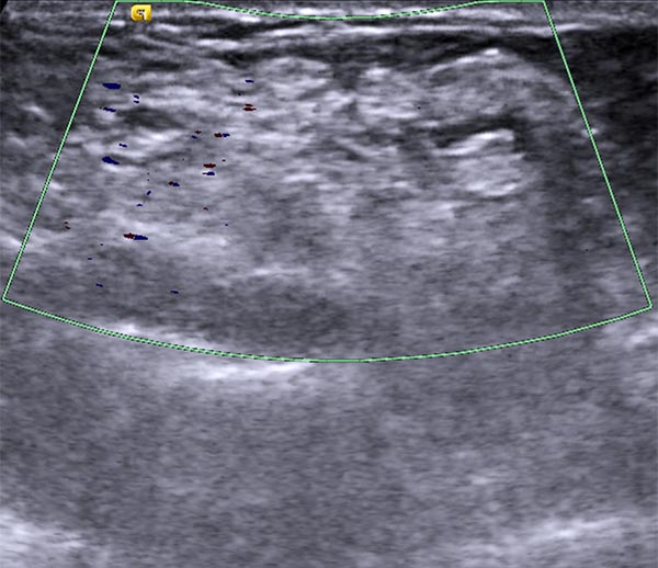 Duplexsonographie – Venöse Malformation an Unterarm