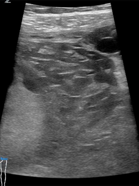 Sonographie – Venöse Malformation des Abdomens