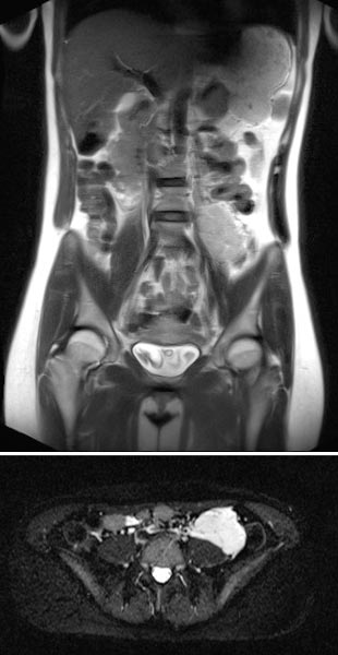 MRT – Venöse Malformation des Abdomens