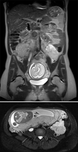 MRT – Venöse Malformation des Abdomens