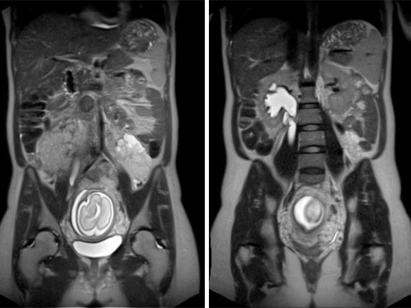 MRT – Venöse Malformation des Abdomens