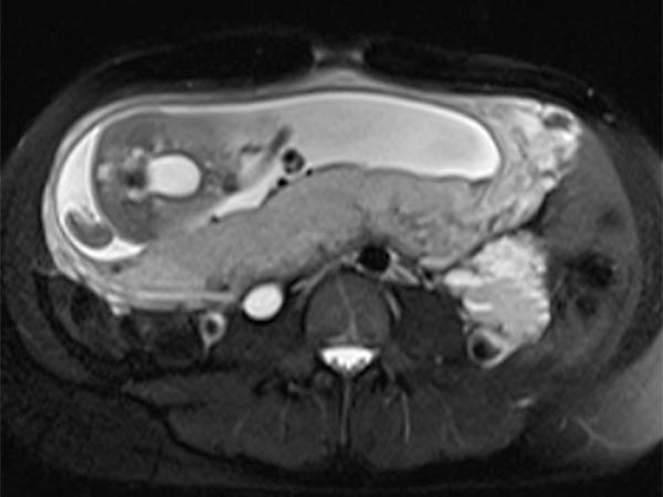 MRT – Venöse Malformation des Abdomens