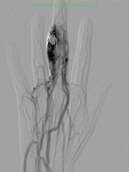 DSA – Arteriovenöse Malformation am Finger