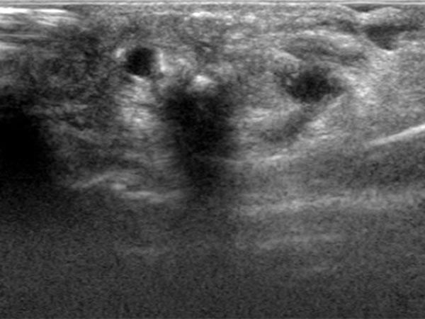 Embolisation – Arteriovenöse Malformation am Finger