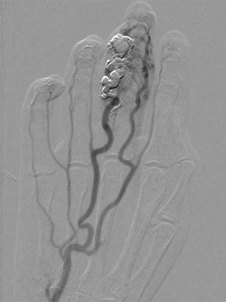 Embolisation – Arteriovenöse Malformation am Finger