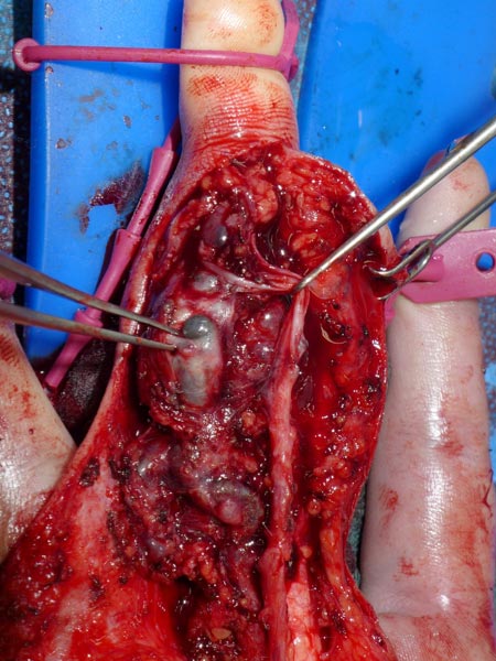 Operation – Arteriovenöse Malformation am Finger