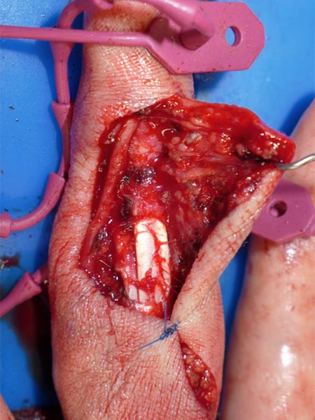 Operation – Arteriovenöse Malformation am Finger