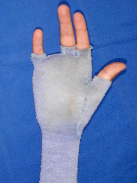 Arteriovenöse Malformation an Hand – Kompressionshandschuh