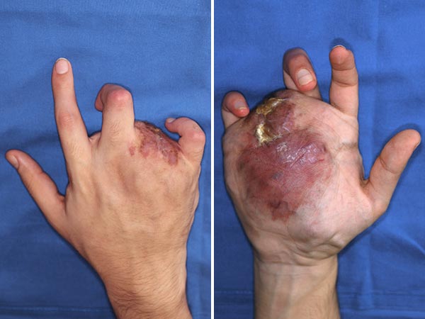 Arteriovenöse Malformation an Hand