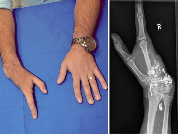 Arteriovenöse Malformation an Hand – Röntgen