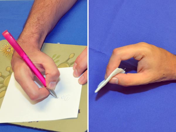 Arteriovenöse Malformation an Hand