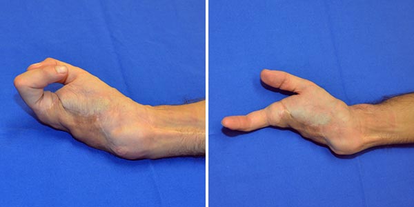 Arteriovenöse Malformation an Hand nach Therapie
