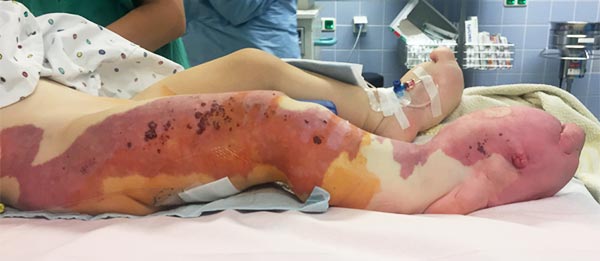 CLOVES-Syndrom an Vorfuß bei Weichteilhyperplasie