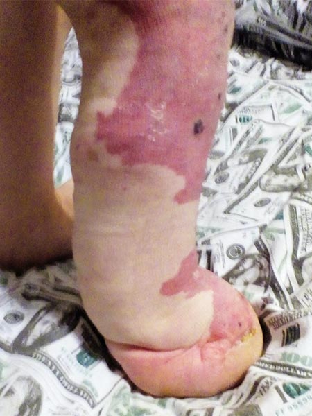 CLOVES-Syndrom – Amputation des  Vorfußes nach OP